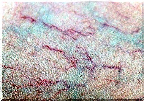 Varicose veins