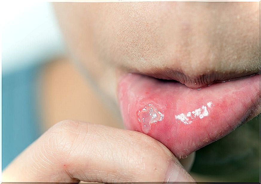 5 remedies to quickly cure a canker sore