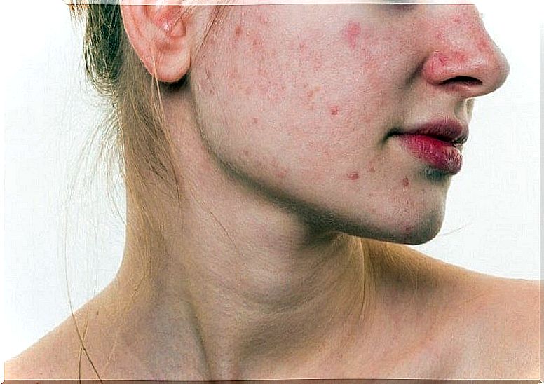 Woman with acne