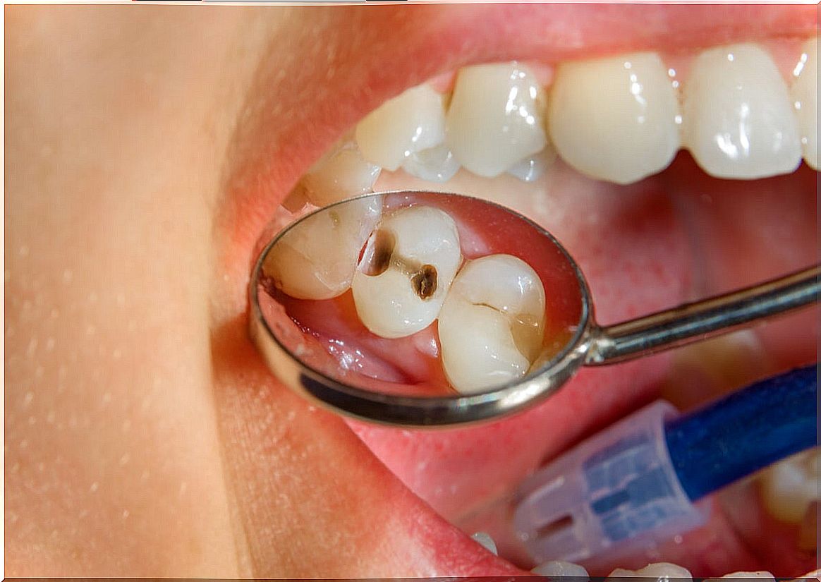 Dental caries as a risk factor for tooth necrosis.