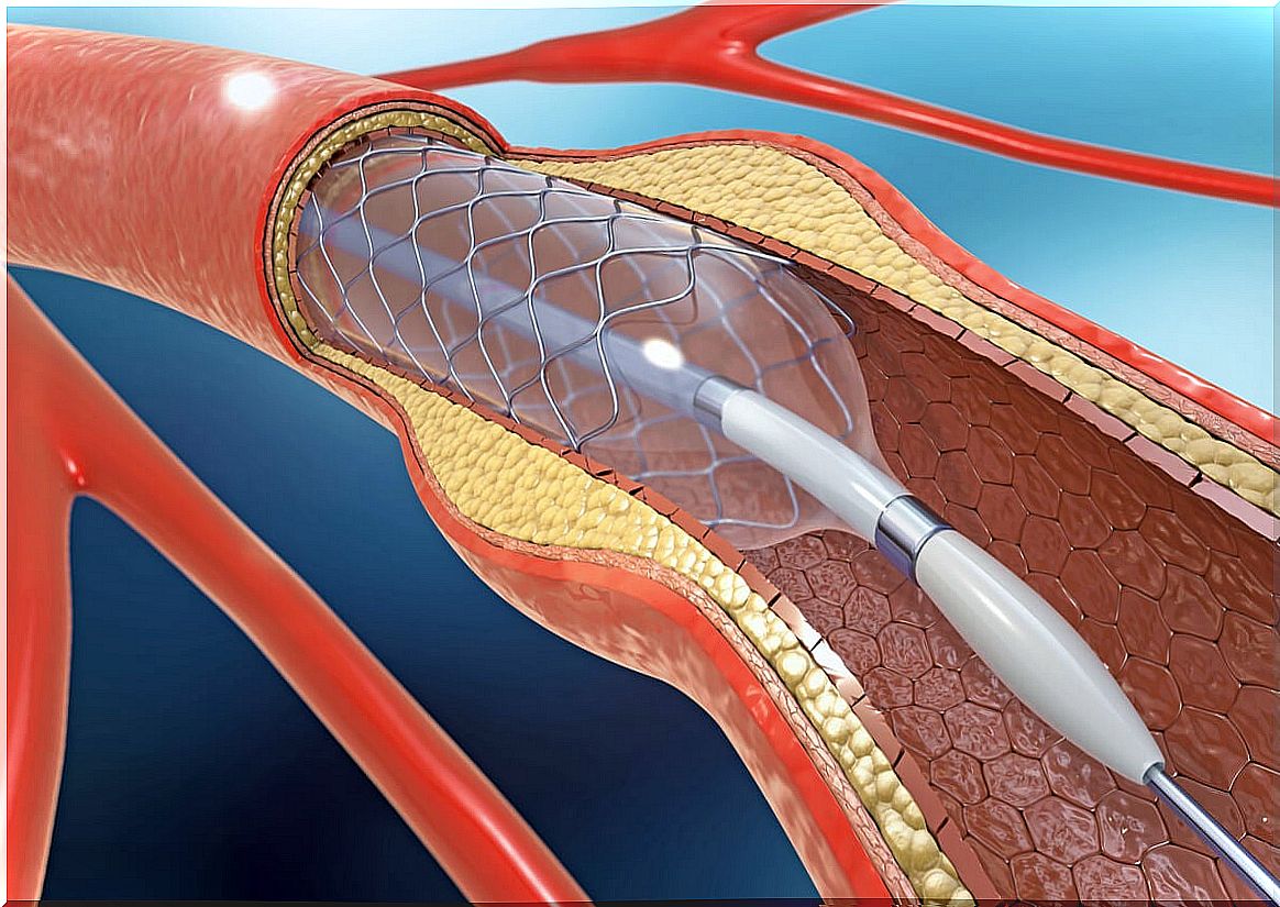 Arteries with arteriosclerosis.