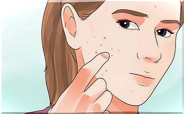 How to differentiate the different types of acne on the face