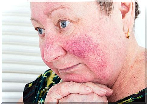 Acne rosacea