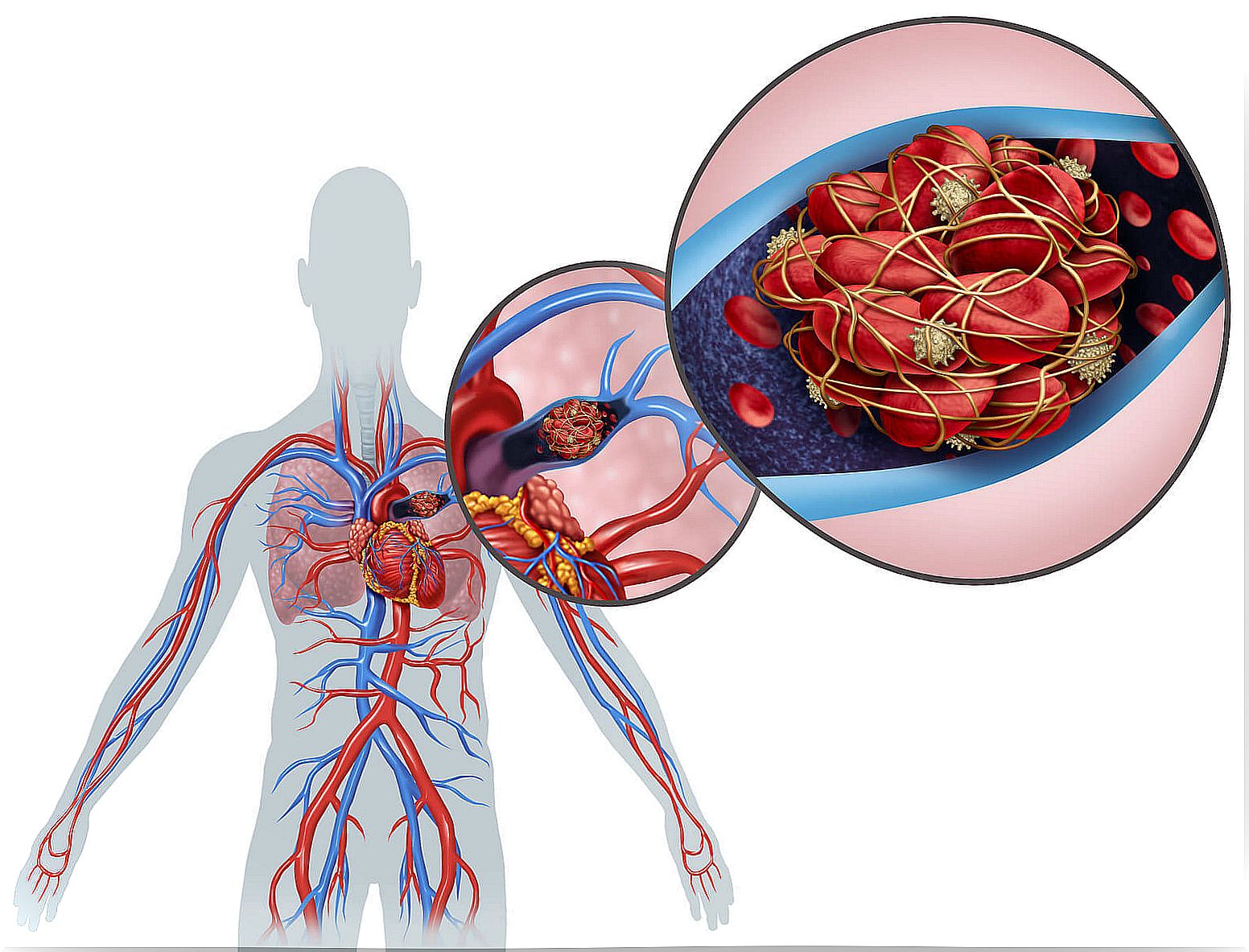 Pulmonary embolism