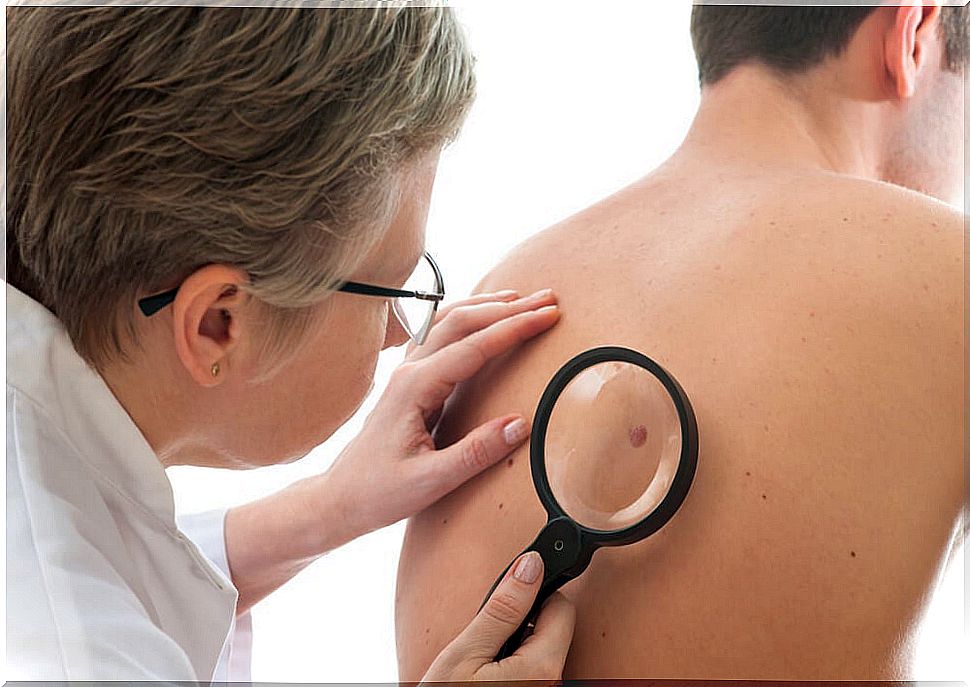 Skin cancer diagnosis