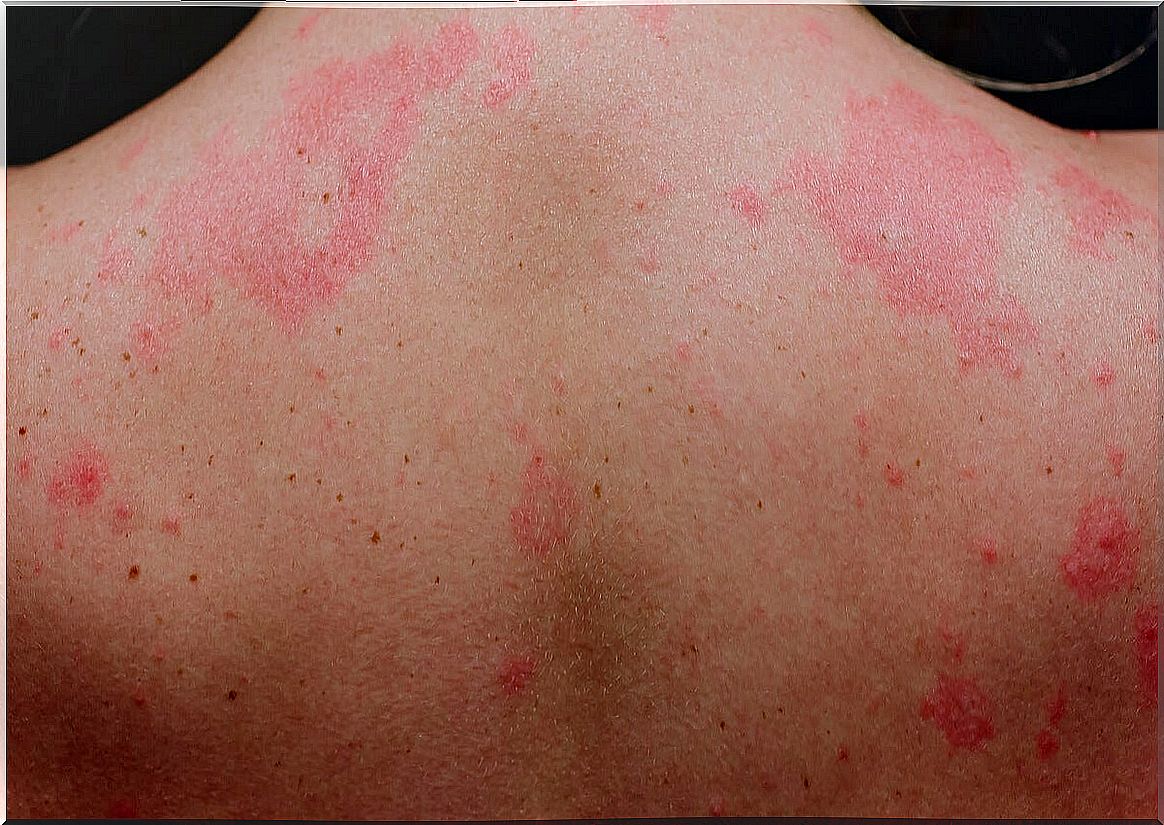 Chronic urticaria on the back